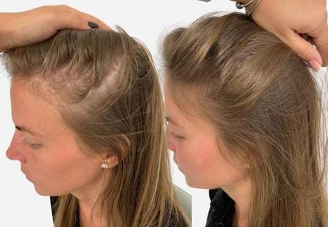 Women hair loss before & after image