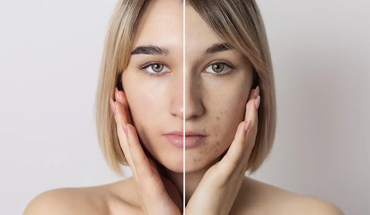 res-light-therapy-after-before